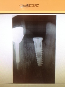 Tooth X-ray